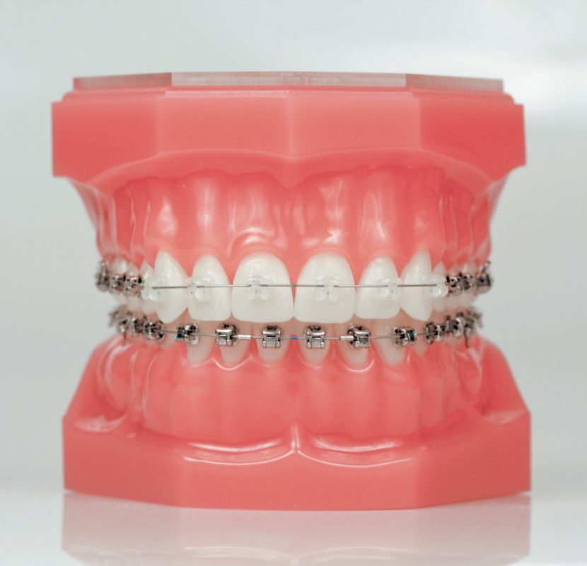 Clear Braces: What Are They? - RSN Dental PC Staten Island New York