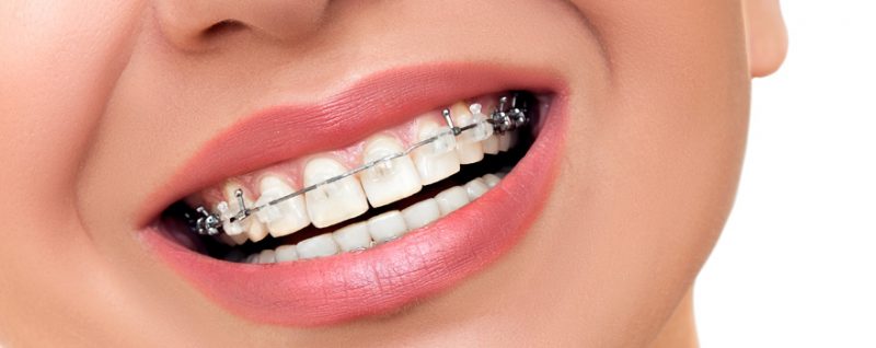 จัดฟันดามอน