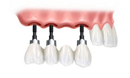 Missing Teeth Replacement - Dental Implant Bridges