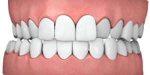 orthodontics-crossbite