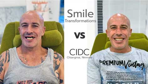 จัดฟัน นิมมาน เชียงใหม่