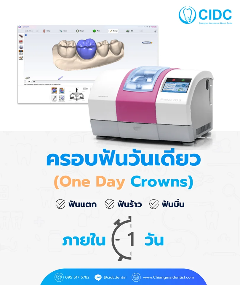 ครอบฟันวันเดียว