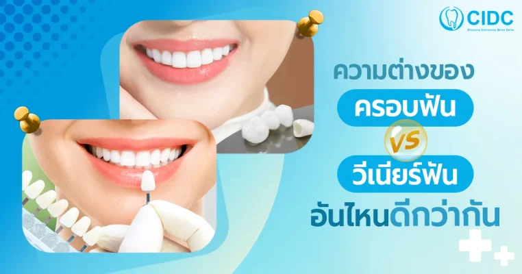 ครอบฟัน วีเนียร์