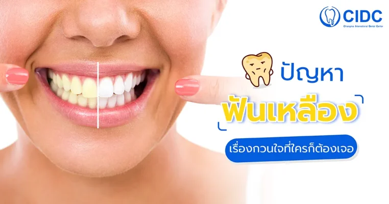 ฟันเหลือง