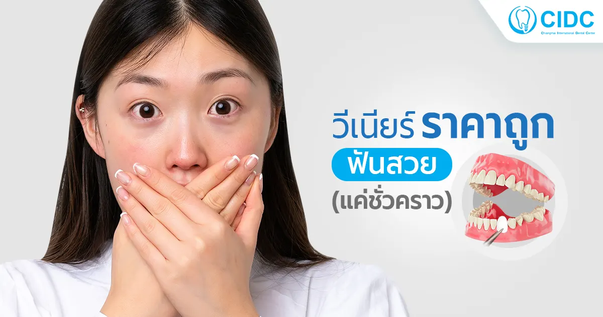 วีเนียร์ราคาถูก