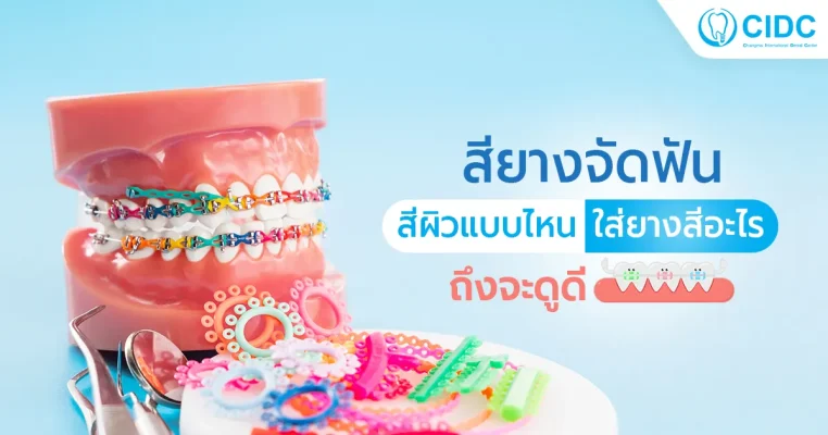 สียางจัดฟัน