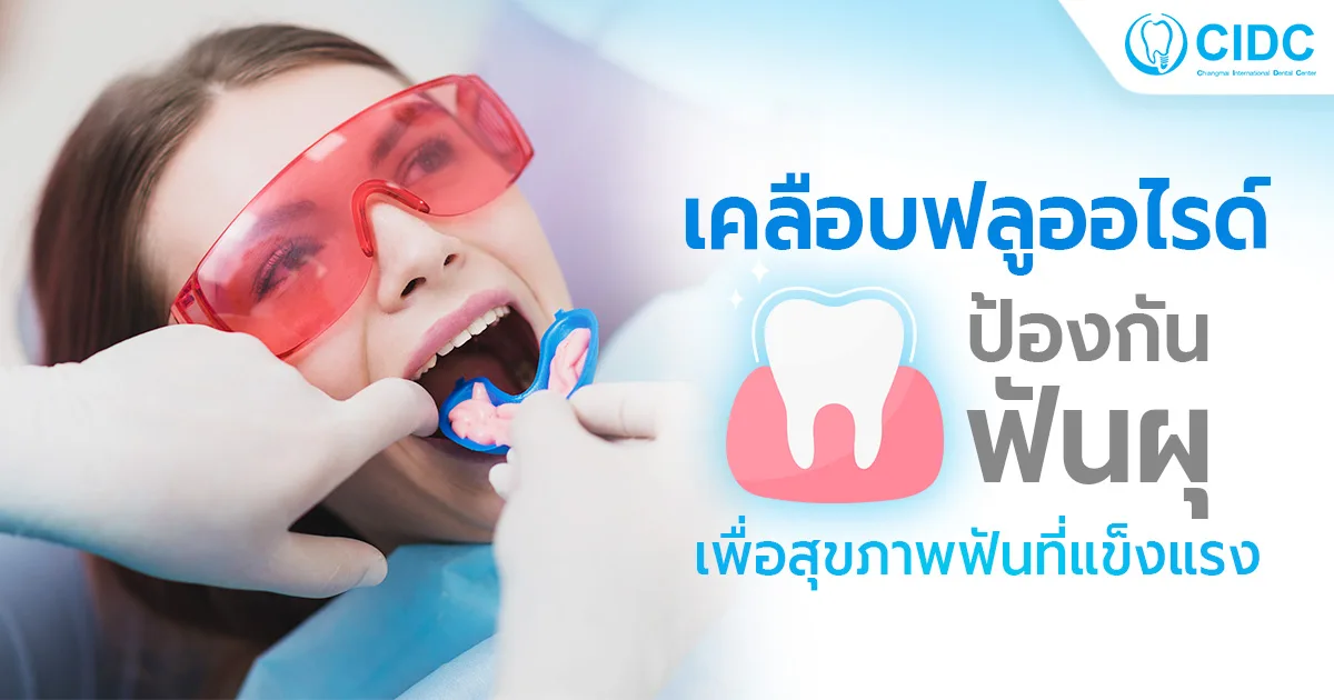 เคลือบฟลูออไรด์