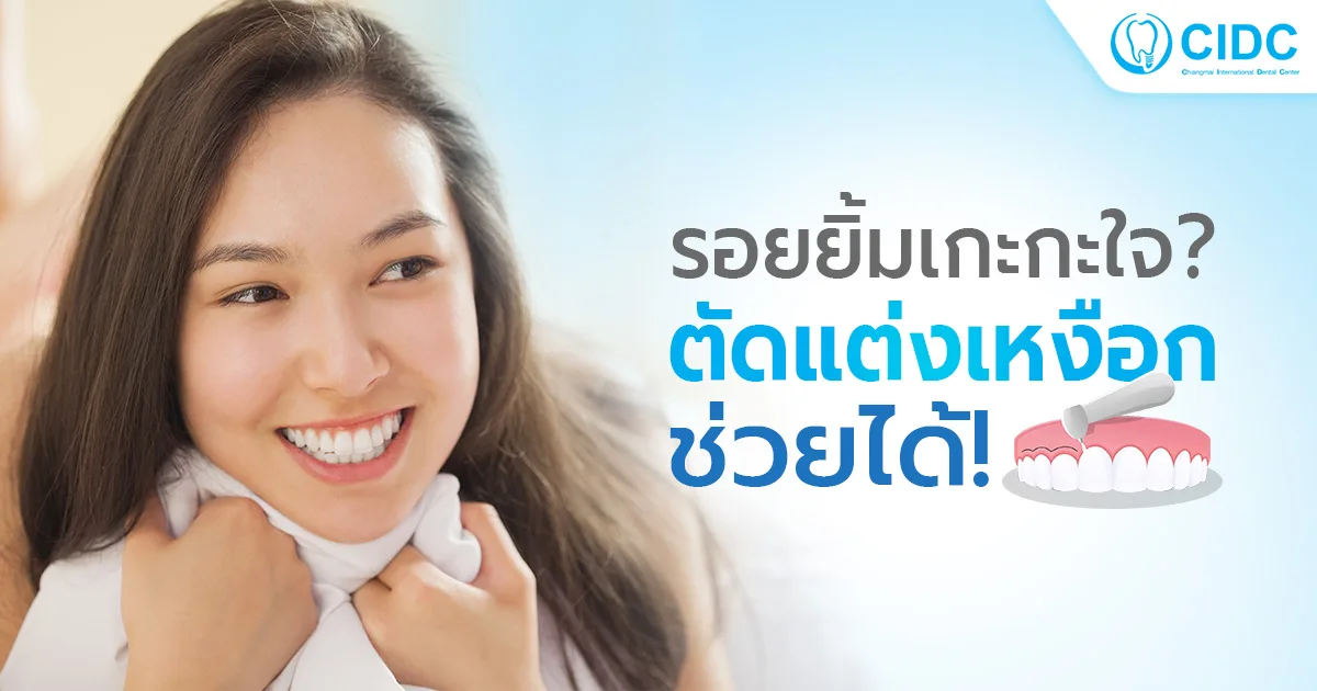 ตัดเหงือก