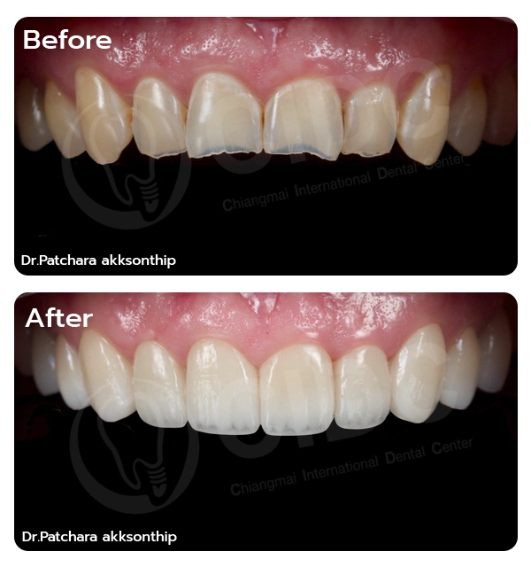 Full Mouth Rehabilitation