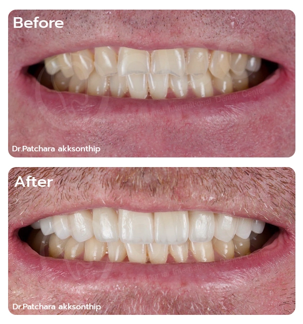 Full Mouth Rehabilitation