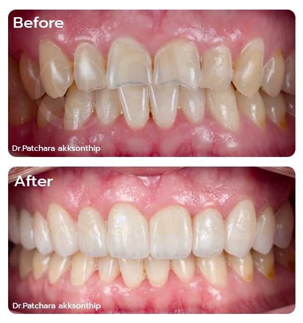 Full Mouth Rehabilitation