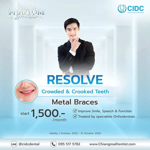 promotion clear braces