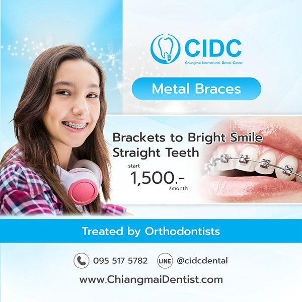 promotion clear braces