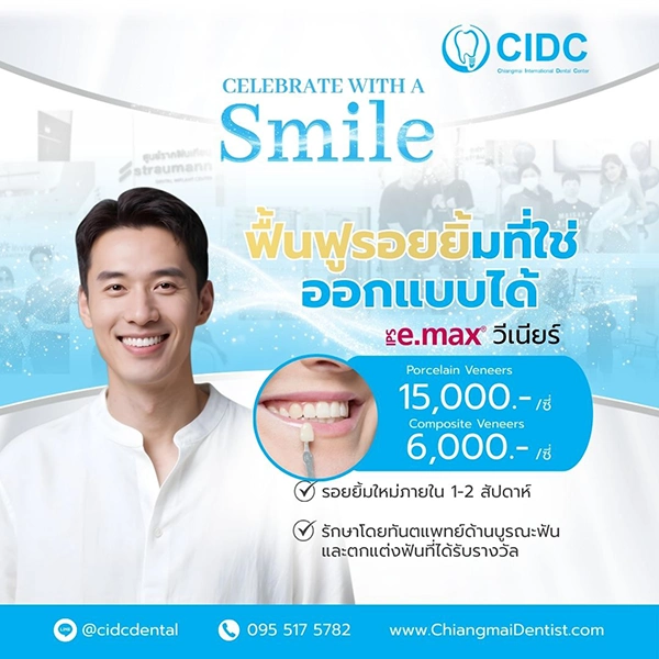 ราคา วีเนียร์เชียงใหม่