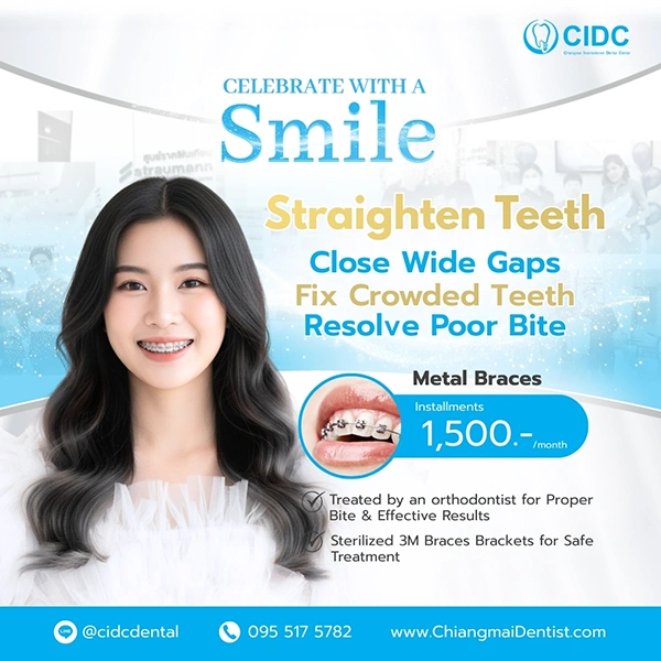 promotion clear braces
