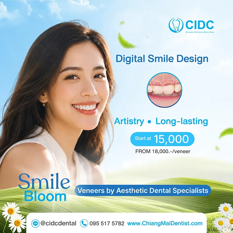 dental veneers 2026