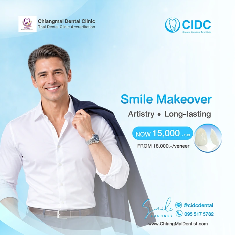 dental veneers 2026