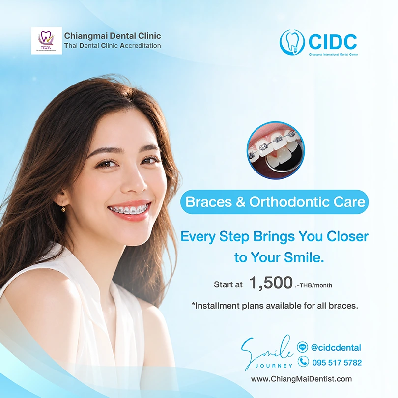 promotion clear braces